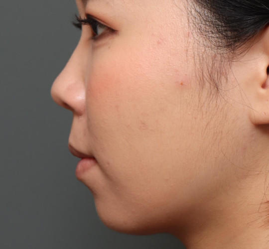 20代女性のメーラーファット除去 Before 症例写真