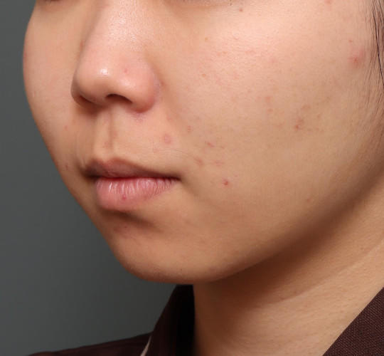 20代女性のメーラーファット除去 Before 症例写真