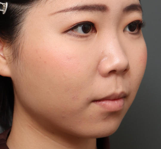 20代女性のVOVリフトプレミアム Before 症例写真