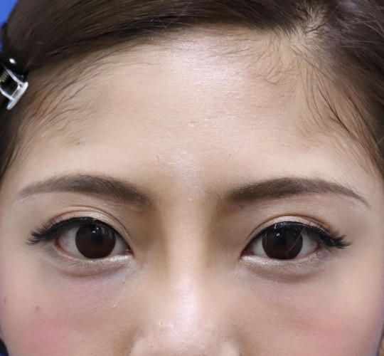 20代女性の眉下切開法 After 症例写真