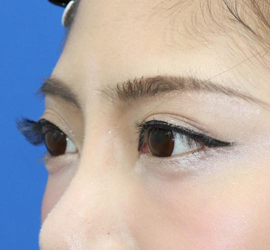 20代女性の眉下切開法 After 症例写真