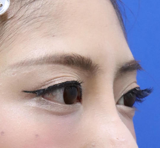 20代女性の眉下切開法 After 症例写真
