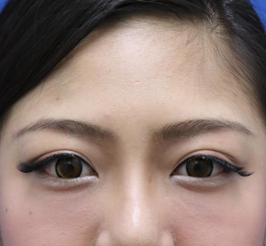 20代女性の眉下切開法 Before 症例写真