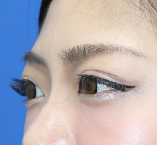 20代女性の眉下切開法 Before 症例写真