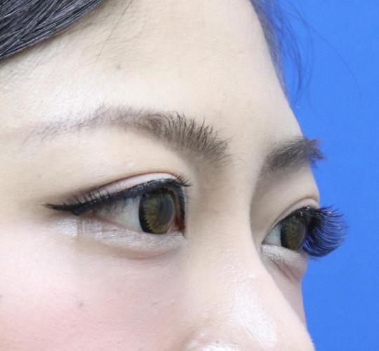 20代女性の眉下切開法 Before 症例写真