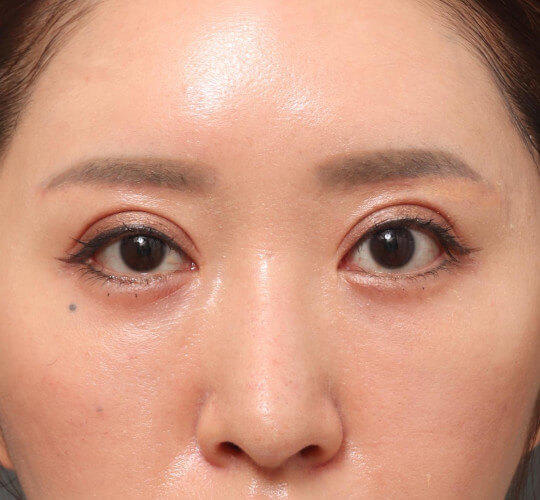 30代女性の眉下切開法 After 症例写真