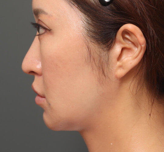 30代女性の眉下切開法 After 症例写真