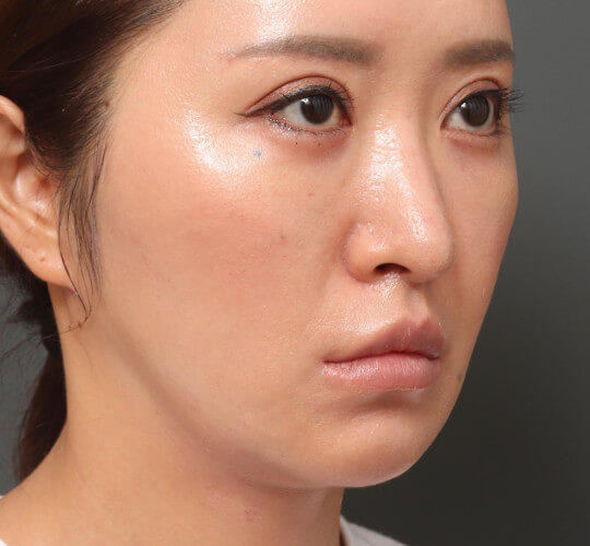 30代女性の顔の脂肪吸引 After 症例写真