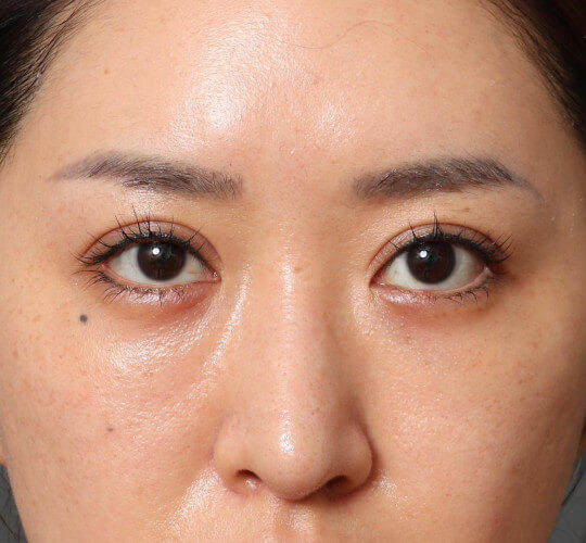 30代女性の眉下切開法 Before 症例写真