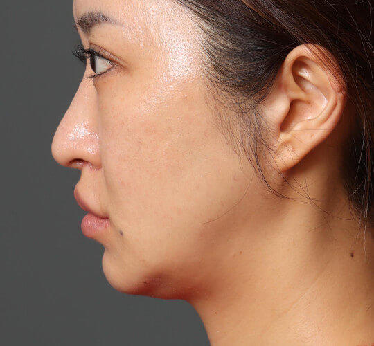 30代女性の眉下切開法 Before 症例写真