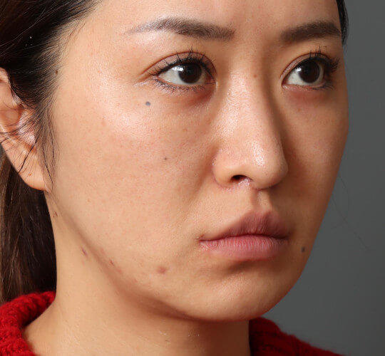 30代女性の顔の脂肪吸引 Before 症例写真