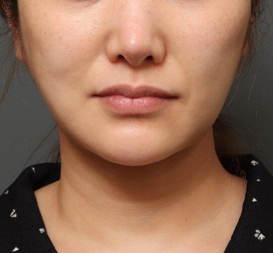 30代女性の顔の脂肪吸引 After 症例写真