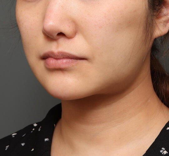 30代女性のメーラーファット除去 After 症例写真