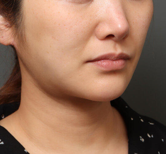 30代女性のメーラーファット除去 After 症例写真