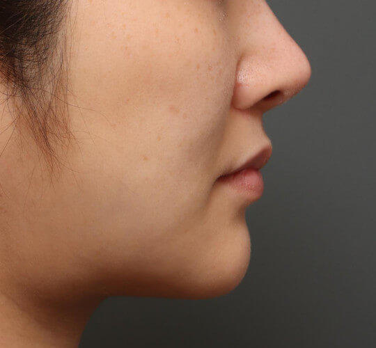 30代女性のメーラーファット除去 After 症例写真