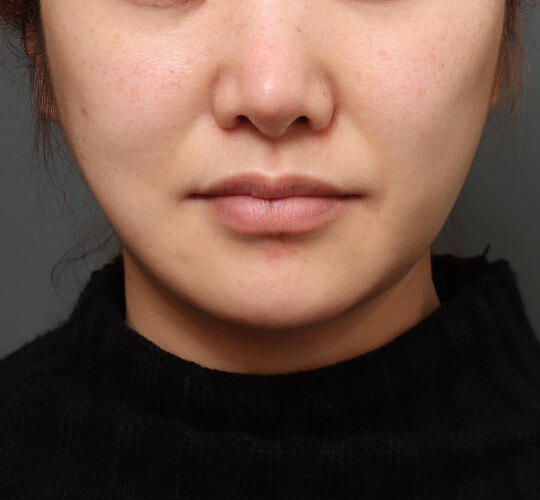30代女性の顔の脂肪吸引 Before 症例写真