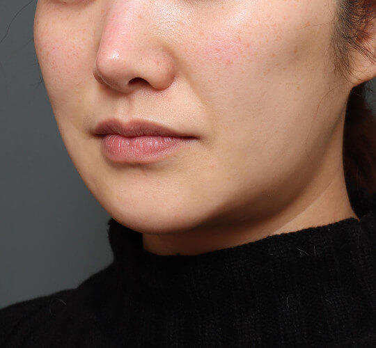 30代女性のメーラーファット除去 Before 症例写真