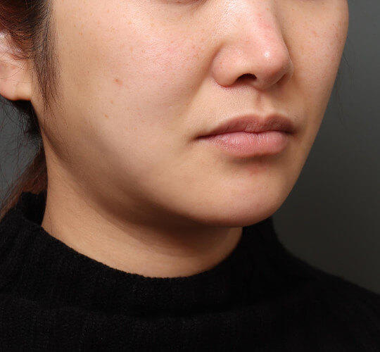 30代女性のメーラーファット除去 Before 症例写真