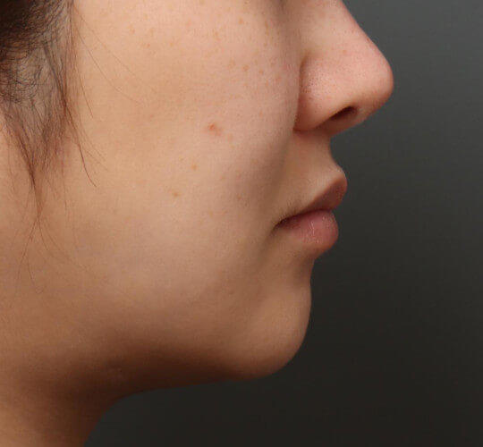 30代女性のメーラーファット除去 Before 症例写真