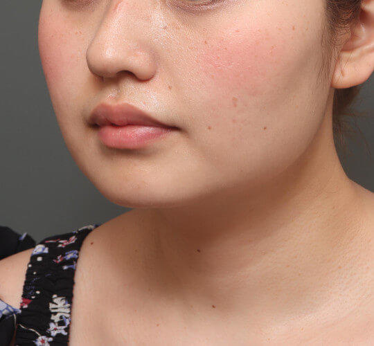 20代女性の顔の脂肪吸引 After 症例写真