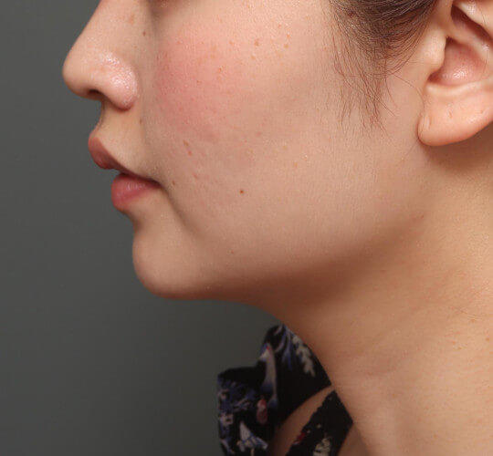 20代女性の顔の脂肪吸引  After 症例写真