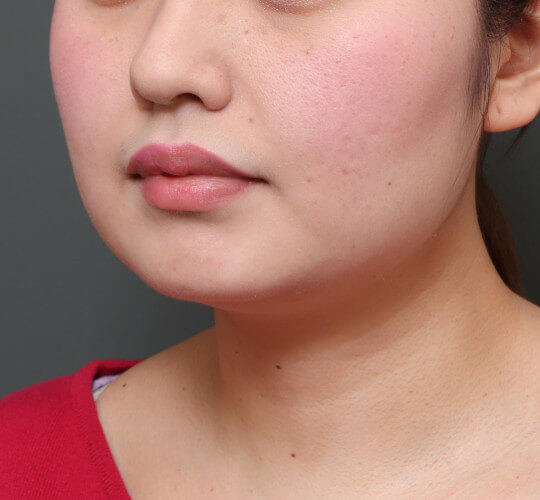 20代女性の顔の脂肪吸引 Before 症例写真