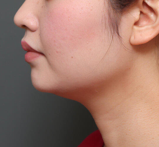 20代女性の顔の脂肪吸引  Before 症例写真