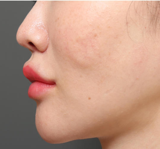 30代女性のアゴプロテーゼ（アゴ整形） After 症例写真