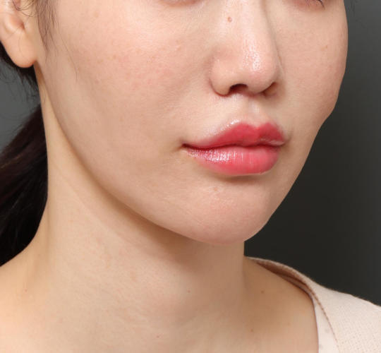 30代女性のアゴプロテーゼ（アゴ整形） After 症例写真