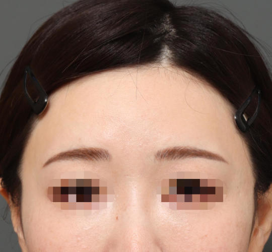 30代女性のアゴプロテーゼ(アゴ整形) After 症例写真