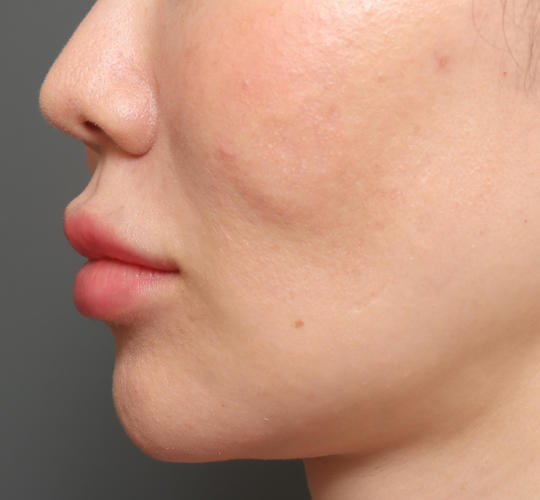 30代女性のアゴプロテーゼ（アゴ整形） Before 症例写真