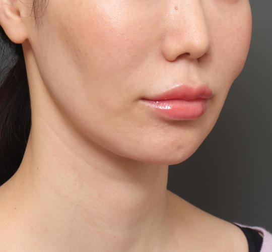 30代女性のアゴプロテーゼ（アゴ整形） Before 症例写真