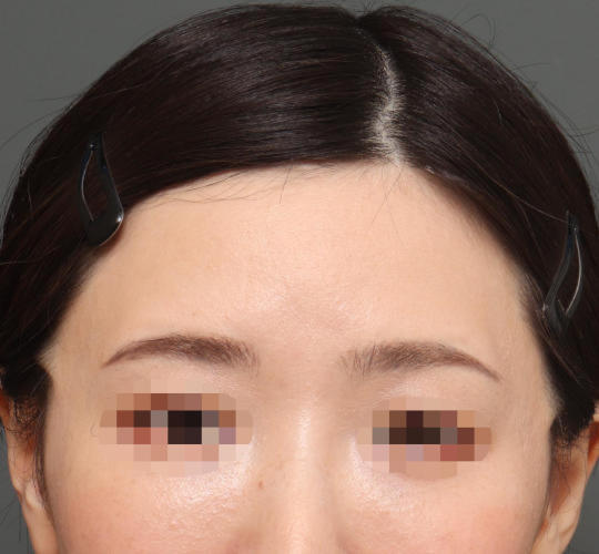 30代女性のアゴプロテーゼ(アゴ整形) Before 症例写真