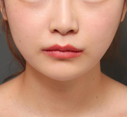 20代女性の鼻の整形 After 症例写真