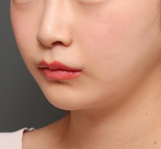 20代女性の人中短縮（リップリフト） After 症例写真