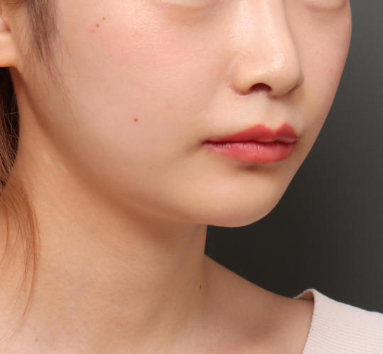 20代女性の人中短縮（リップリフト） After 症例写真
