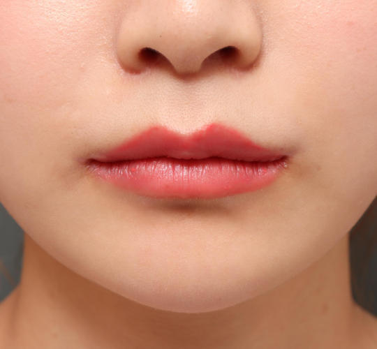 20代女性の人中短縮（リップリフト） After 症例写真