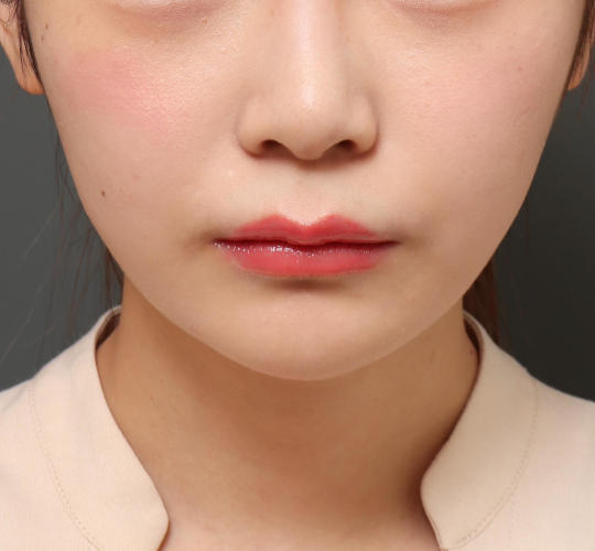 20代女性の鼻の整形 Before 症例写真