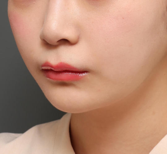 20代女性の人中短縮（リップリフト） Before 症例写真