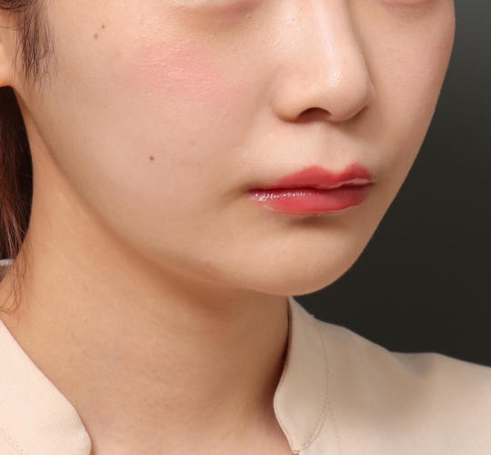 20代女性の人中短縮（リップリフト） Before 症例写真