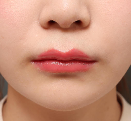 20代女性の人中短縮（リップリフト） Before 症例写真