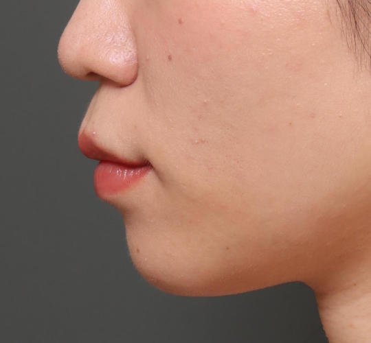 20代女性の人中短縮（リップリフト） Before 症例写真