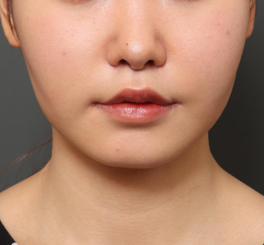 20代女性の人中短縮（リップリフト） After 症例写真