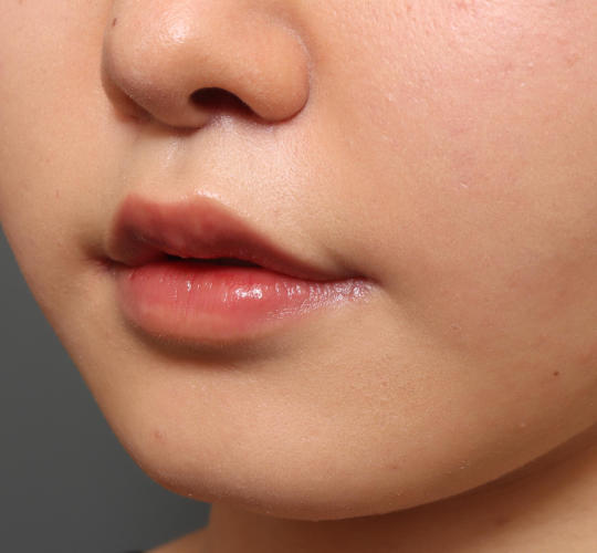 20代女性の人中短縮（リップリフト） After 症例写真