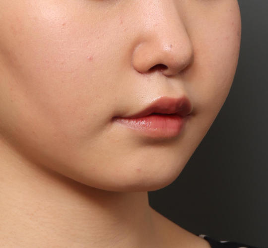 20代女性の人中短縮（リップリフト） After 症例写真