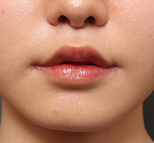 20代女性の人中短縮（リップリフト） After 症例写真