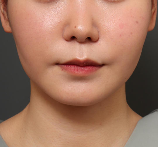 20代女性の人中短縮（リップリフト） Before 症例写真
