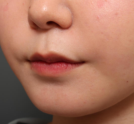 20代女性の人中短縮（リップリフト） Before 症例写真