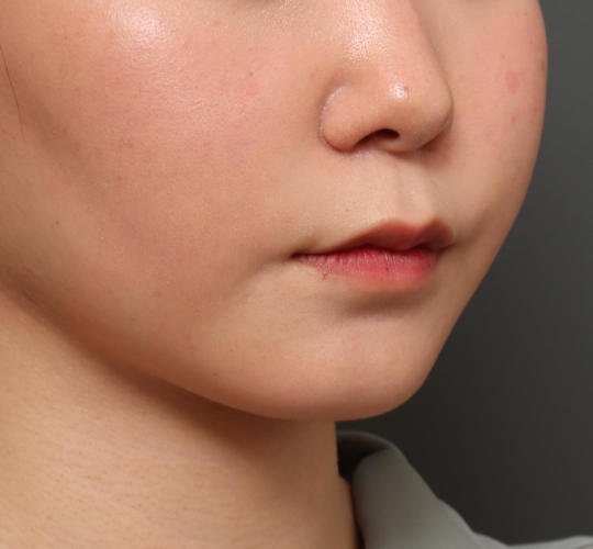 20代女性の人中短縮（リップリフト） Before 症例写真