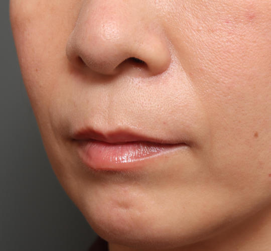 40代女性の人中短縮（リップリフト） Before 症例写真